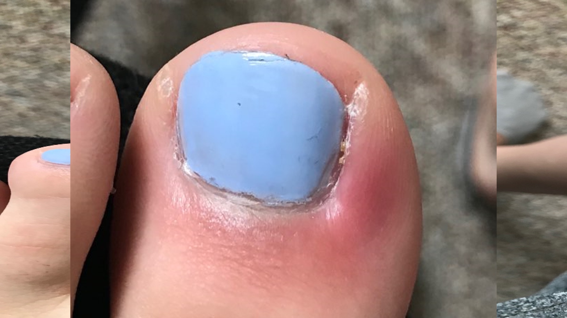Two locals complain of toe infections following pedicures