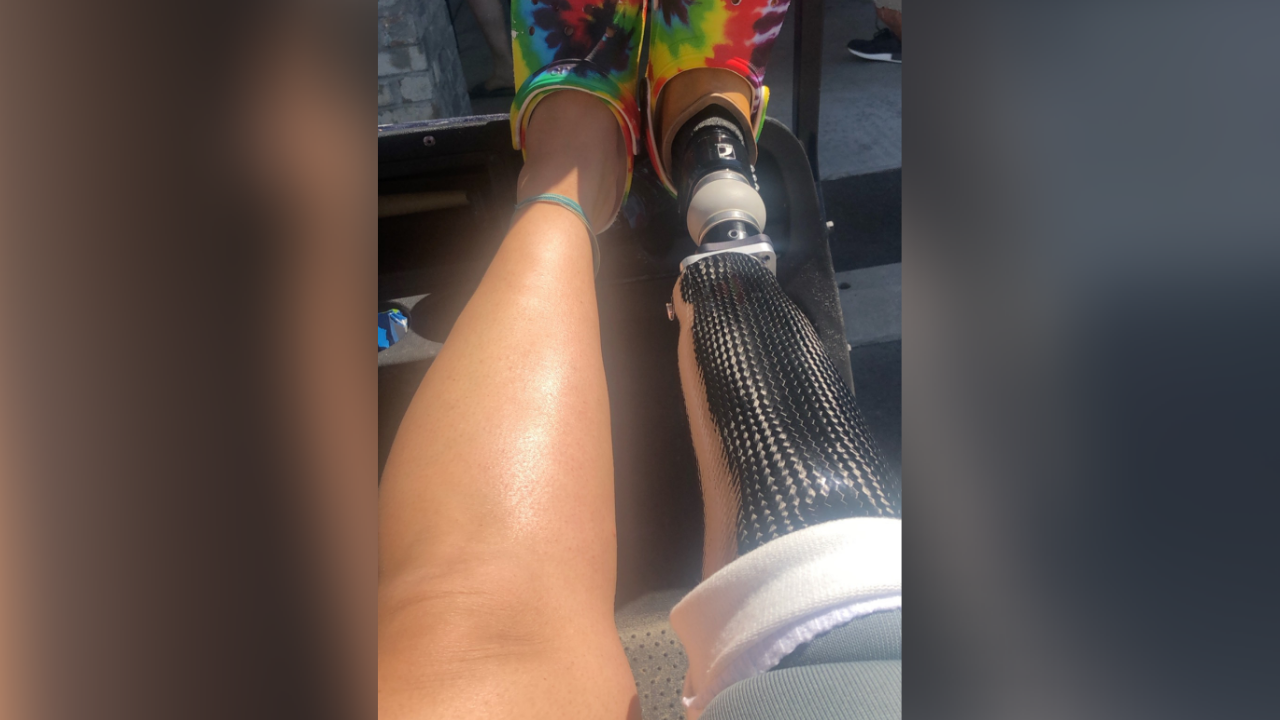 woman above knee prosthetic leg