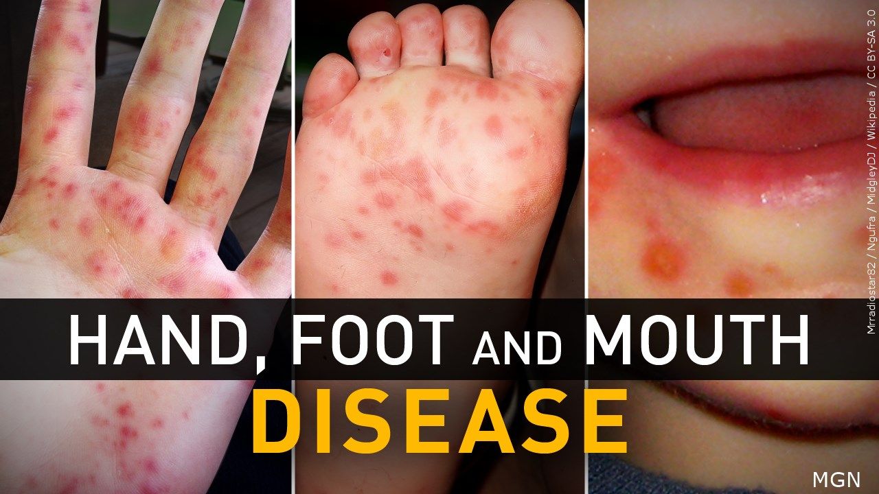 Child Rash On Face Hands And Feet