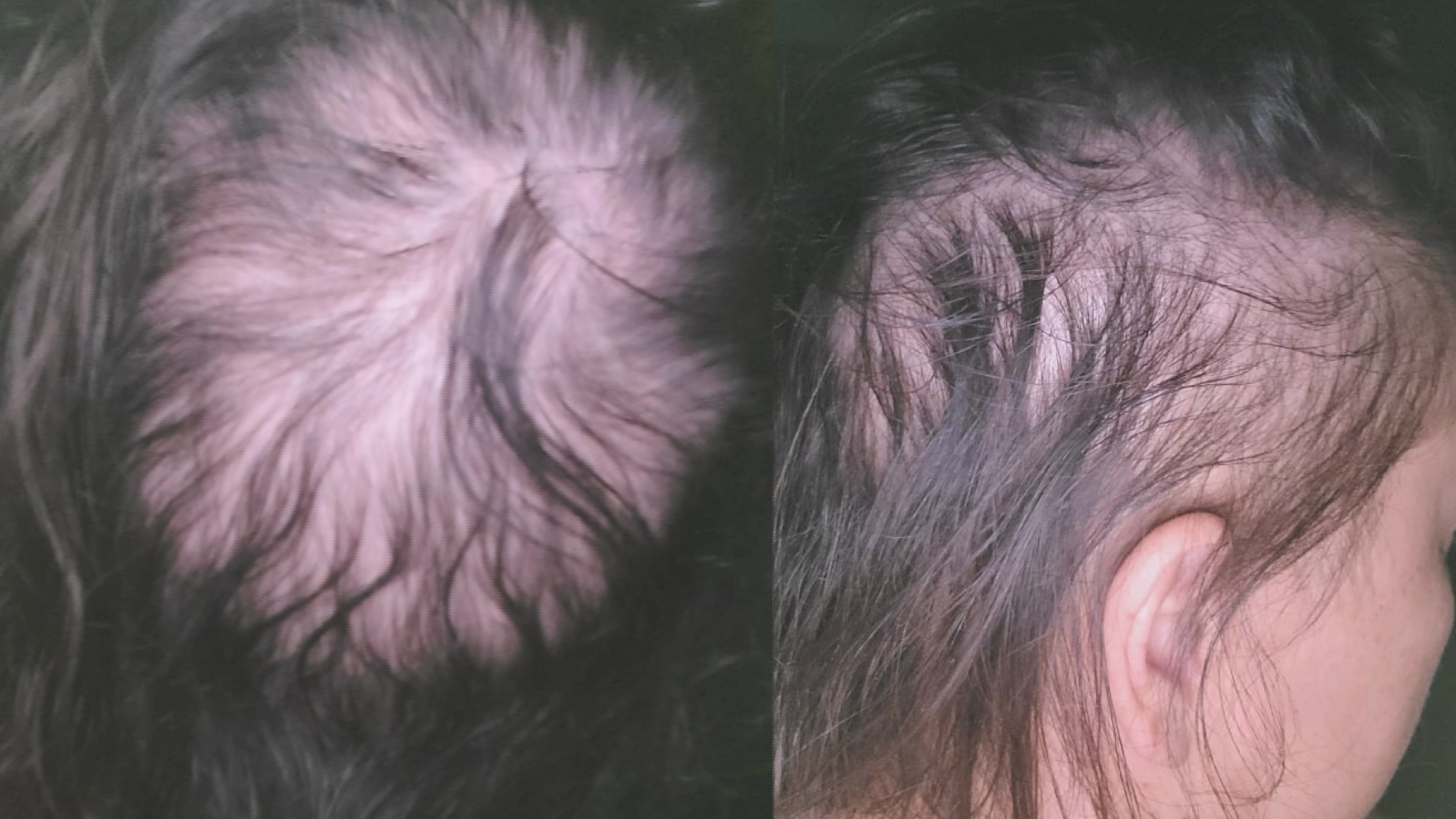 Central Texas women experiencing hair loss after COVID-19