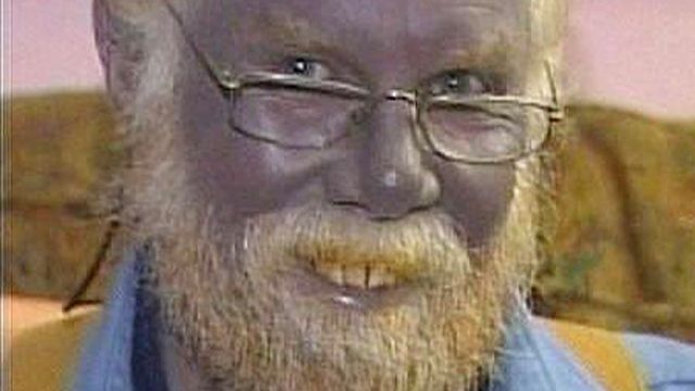 Man who turned blue after taking silver for skin condition dies