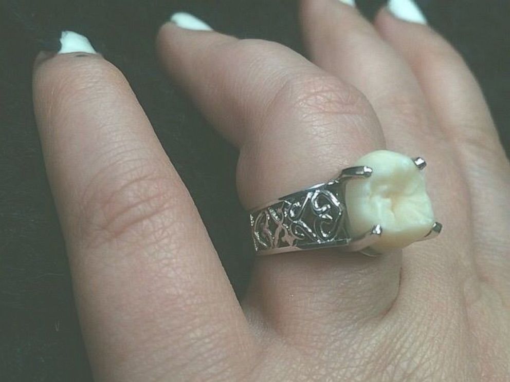 Man proposes to girlfriend with a ring made from his wisdom tooth