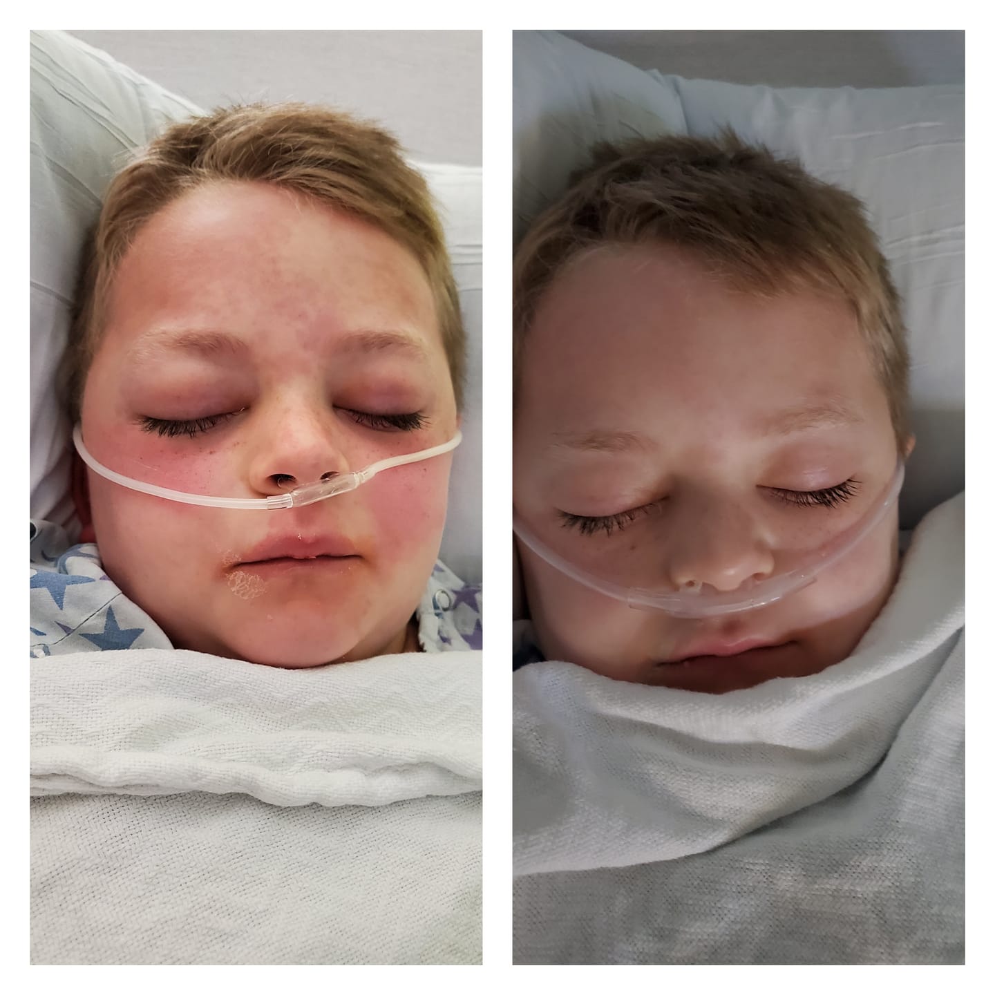 mis c red lips Everything about her just looked so bad': 5-year-old Polk County child recovers from MIS-C, rare condition affecting children WFTV 6-year-old diagnosed with MIS-C released