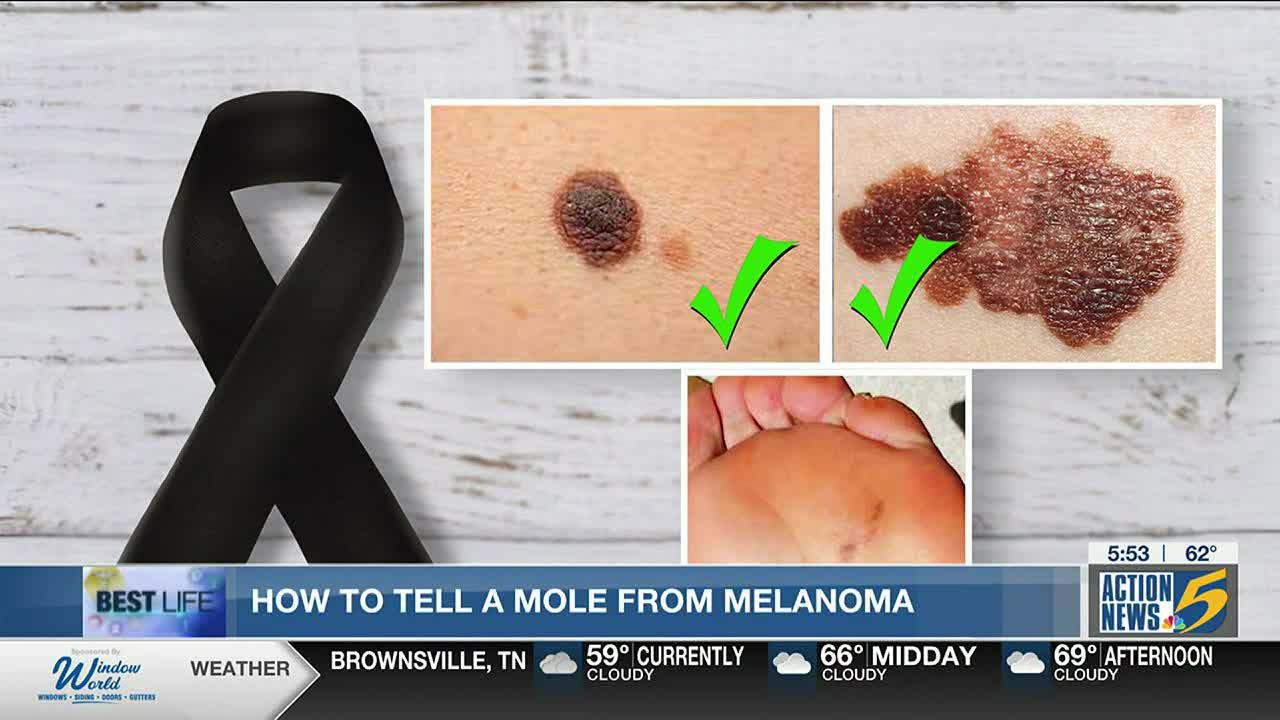 Best Life How to tell a mole from melanoma