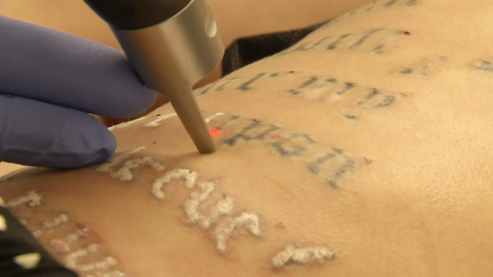 New laser cuts down tattoo removal time