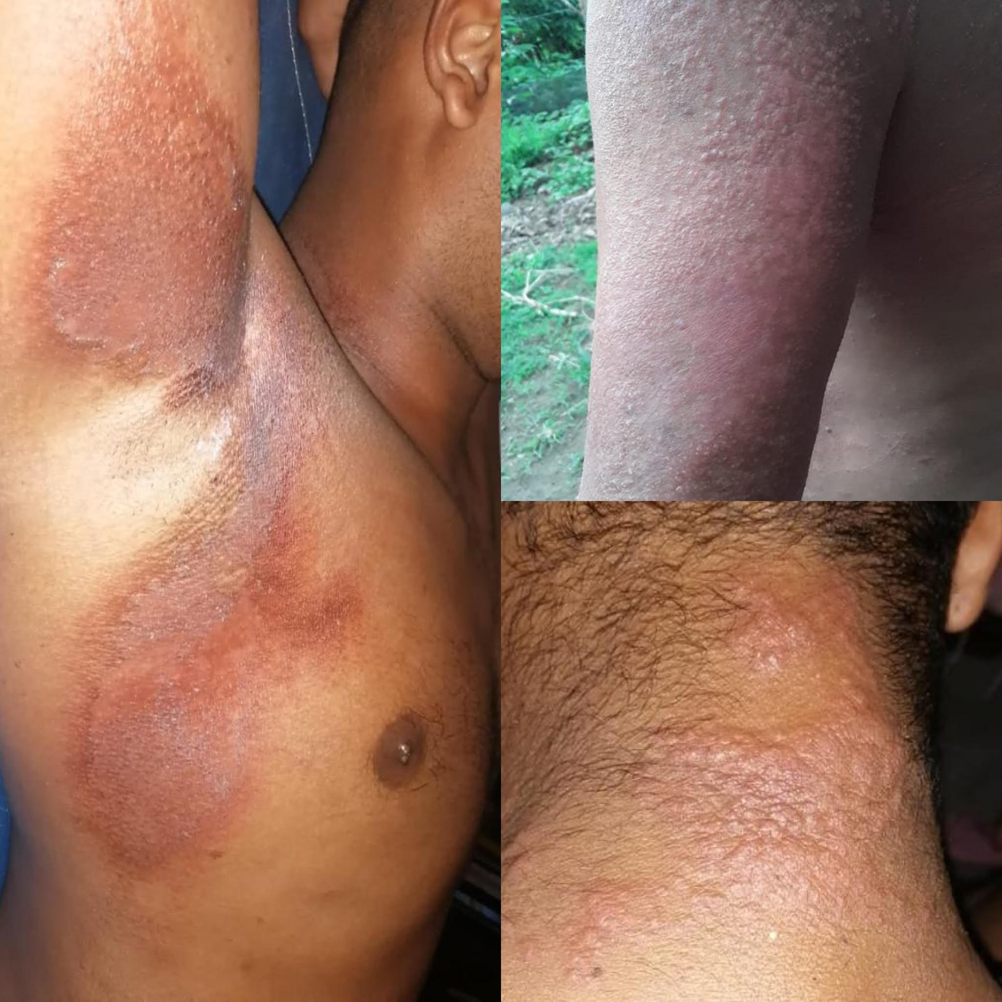 Las imágenes, entregadas por varios trabajadores de bananeras, muestras las lesiones en su piel luego de tener contacto con un químico llamado Movento 15 OD.