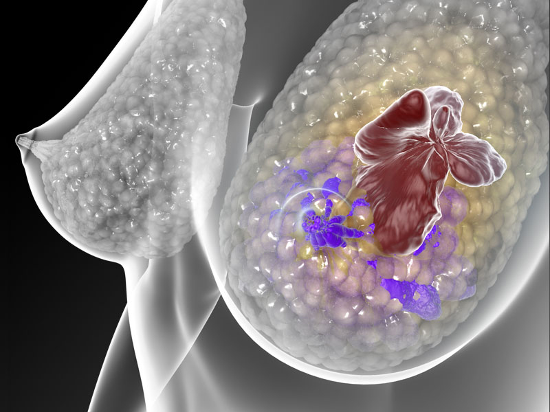 Las proteínas que regulan ciertos genes pueden crear “caminos” para el desarrollo de cáncer de mama y metástasis en la piel u otros órganos. | CHRIS BICKEL /SCIENCE SIGNALING (2016)