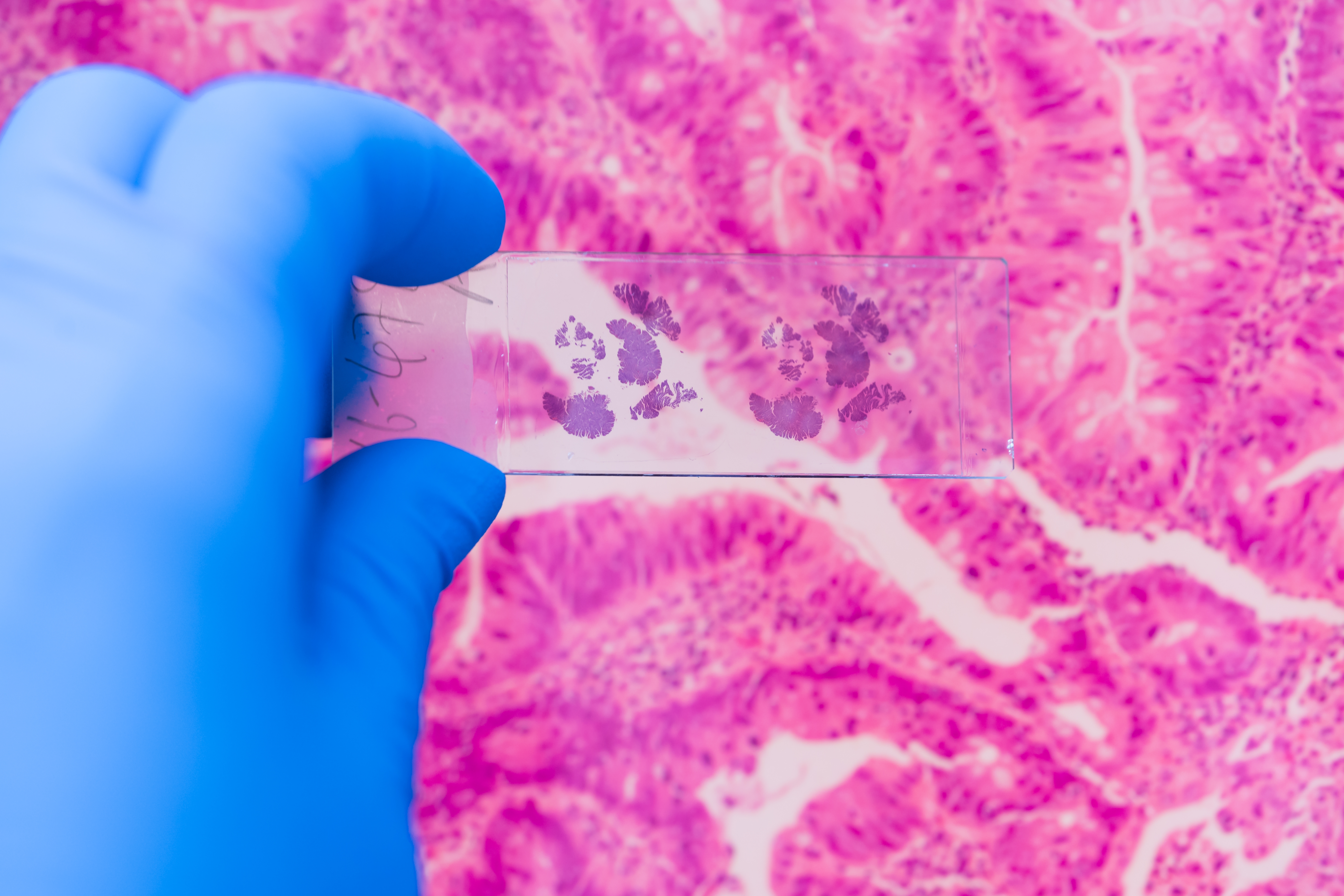 Mano con un guante de laboratorio sostiene una lámina con una biopsia, de fondo se ven imágenes de patología de células cancerosas.