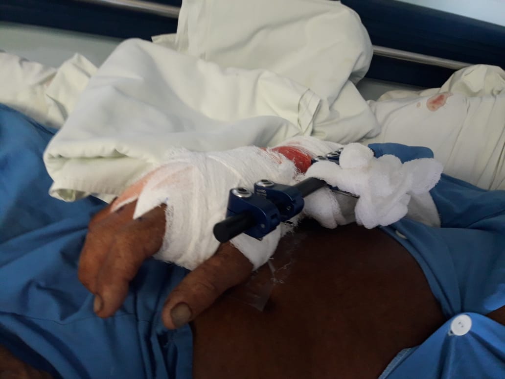 Con una cirugía de urgencia y dispositivos metálicos, se pretende salvar el brazo derecho del peón, que fue mordido por el cocodrilo. Foto: Alfonso Quesada.
