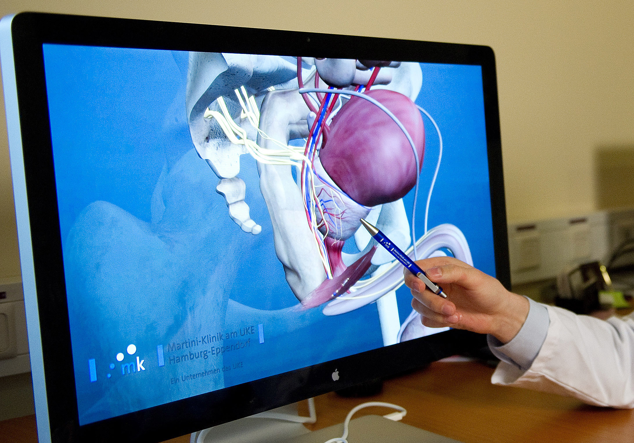 Un médico enseña una próstata en una imagen 3D. Si se detecta un tumor, no siempre debe ser extirpado. Los médicos suelen decidirlo en base al tamaño del tumor y la edad del paciente.