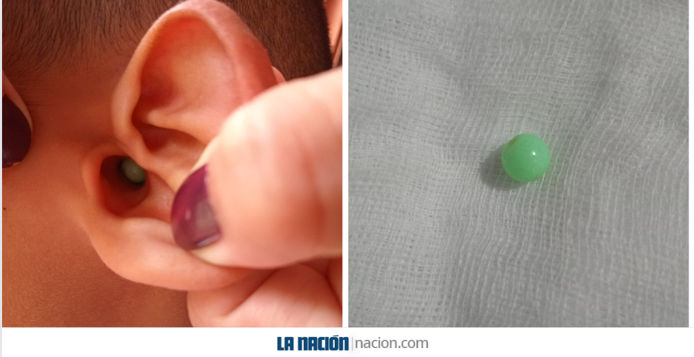 El estudiante de 10 años tuvo dentro de su oído una canica luego de que, según cuenta, un compañero se la introdujera. Luego de extraer el objeto, los médicos le dijeron a la madre que si el niño presenta dolor, que lo lleve al centro médico inmediatamente. Foto: Cortesía