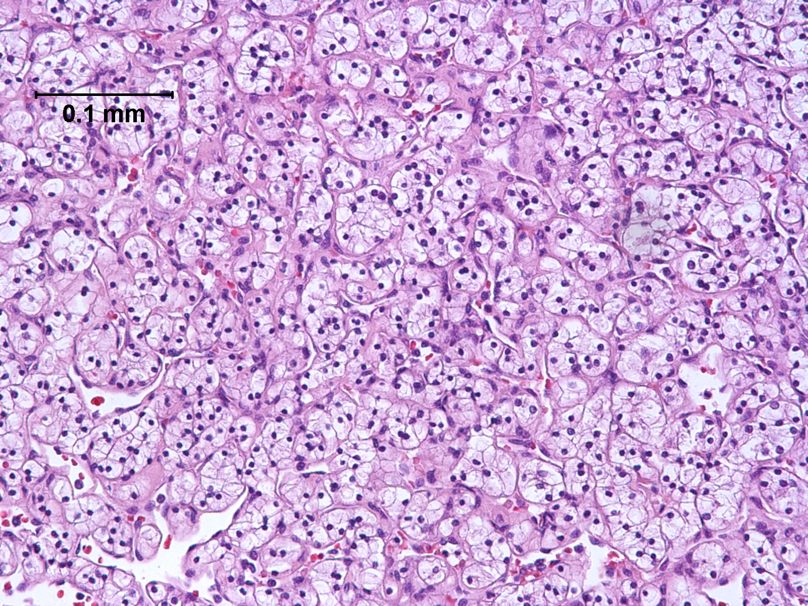 Esta imagen muestra algunas células cancerosas. Fotografía con fines ilustrativos.