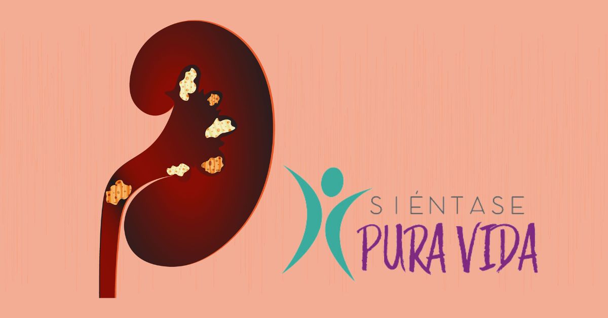 Las piedras en los riñones también se conocen como cálculos renales.
Ilustración: Shutterstock
