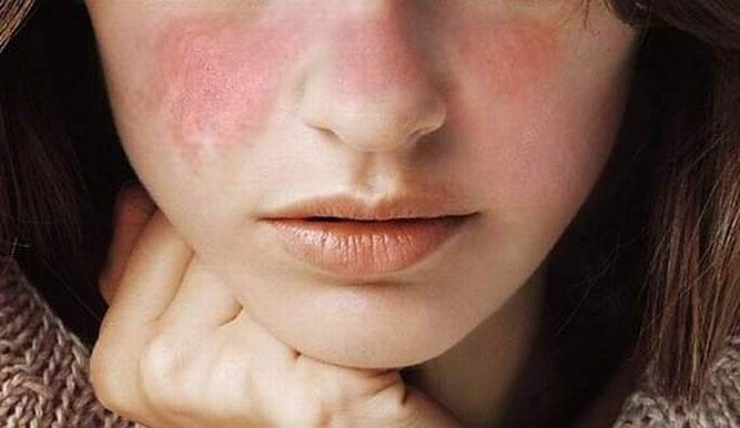 Lupus