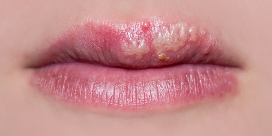 Los investigadores estudian posibles vacunas y agentes antimicrobianos para detener el herpes.