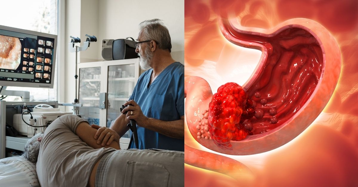 Una composición de imágenes. A la izquierda, un hombre es sometido a una gastroscopia. A la derecha, una ilustración científica de un cáncer de estómago.