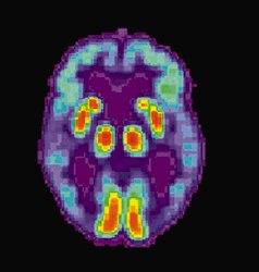 Imágen de un cerebro con alzheimer