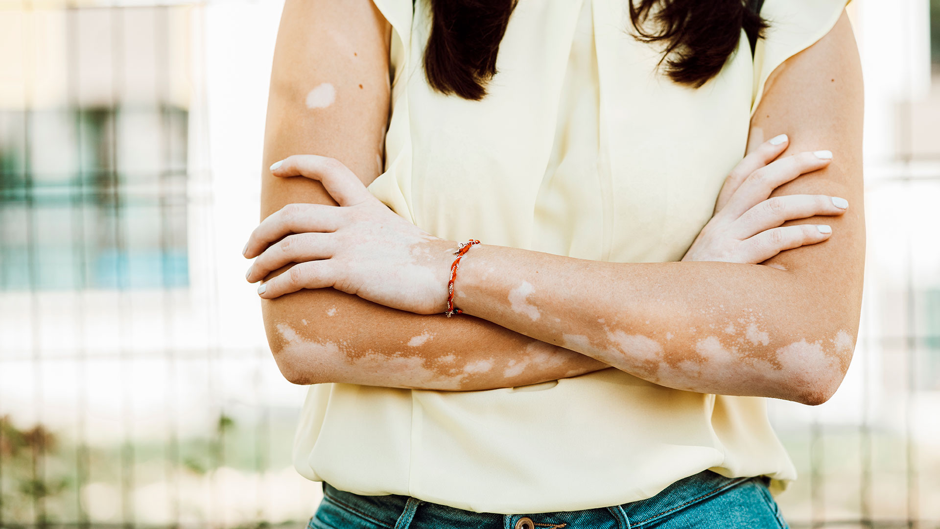 La sobreexposición al sol sin protección, enfermedades de la piel como el vitíligo o la dermatitis atópica y desequilibrios en la alimentación son algunos de los factores más comunes de las manchas blancas en la piel (Getty)

