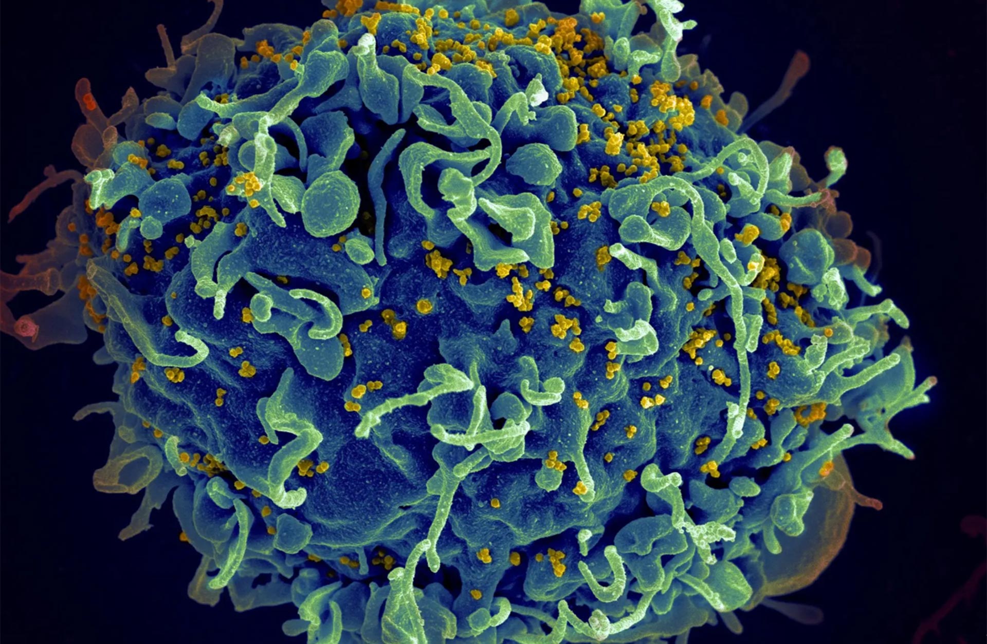 Una célula-T humana, en azul, atacada por el VIH, en amarillo