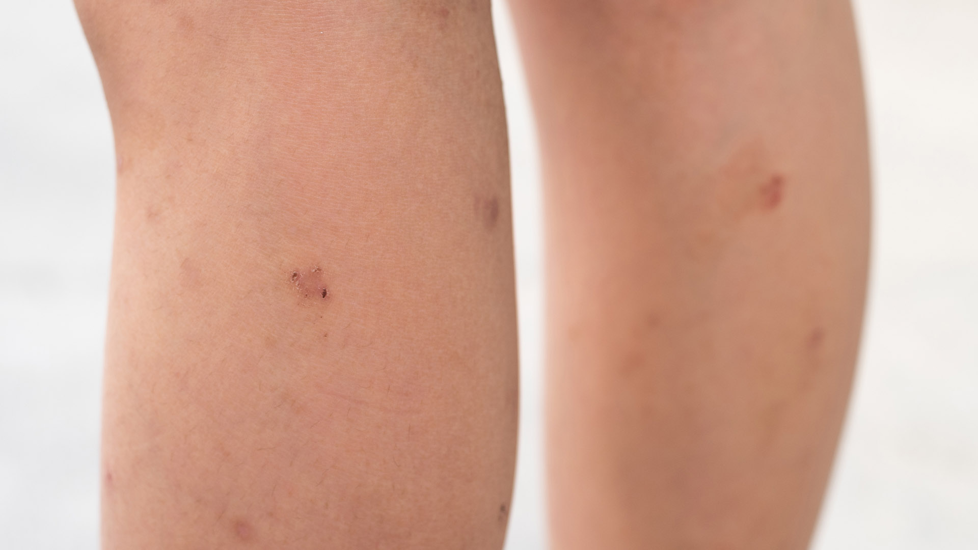 Los tumores (lesiones) del sarcoma de Kaposi suelen manifestarse como puntos violáceos indoloros en las piernas, los pies o el rostro(Shutterstock)
