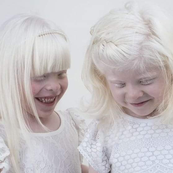 Valentina y Mailén, las mellizas albinas. Sus padres impulsan la Ley Nacional de Albinismo que, luego de recibir media sanción en el senado, por la pandemia perdió estado parlamentario