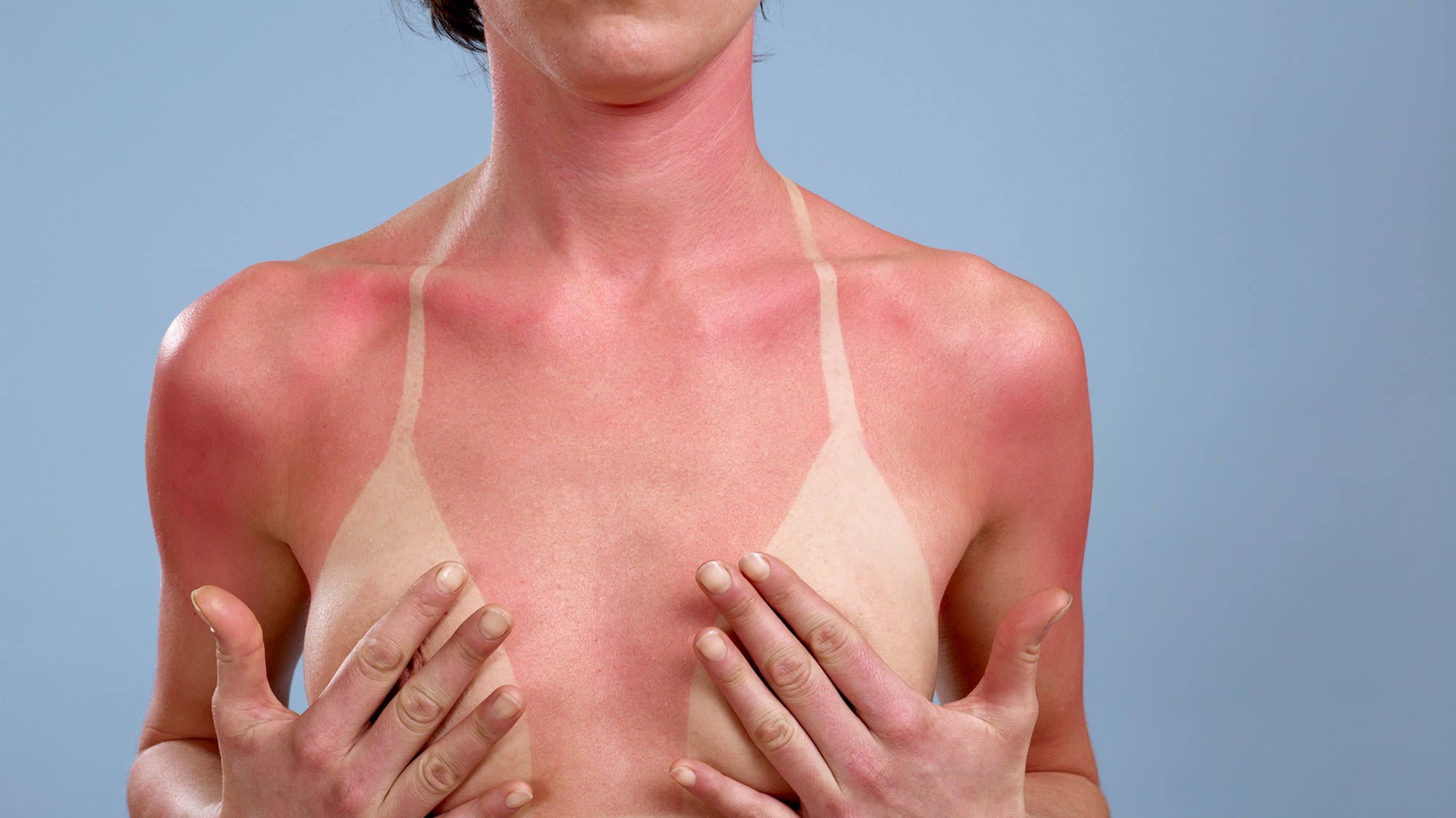 La exposición al sol sin protector, puede generar quemaduras de piel 