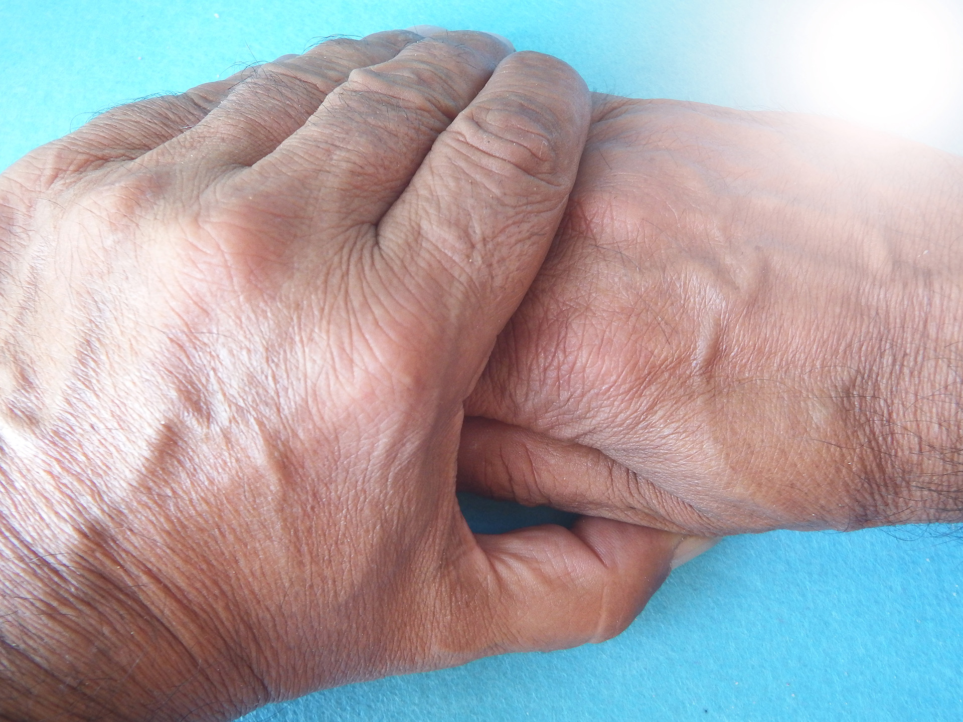 Los síntomas de la Enfermedad de Parkinson incluyen aquellos que afectan el movimiento: temblor, rigidez muscular y lentitud
(Getty Images)