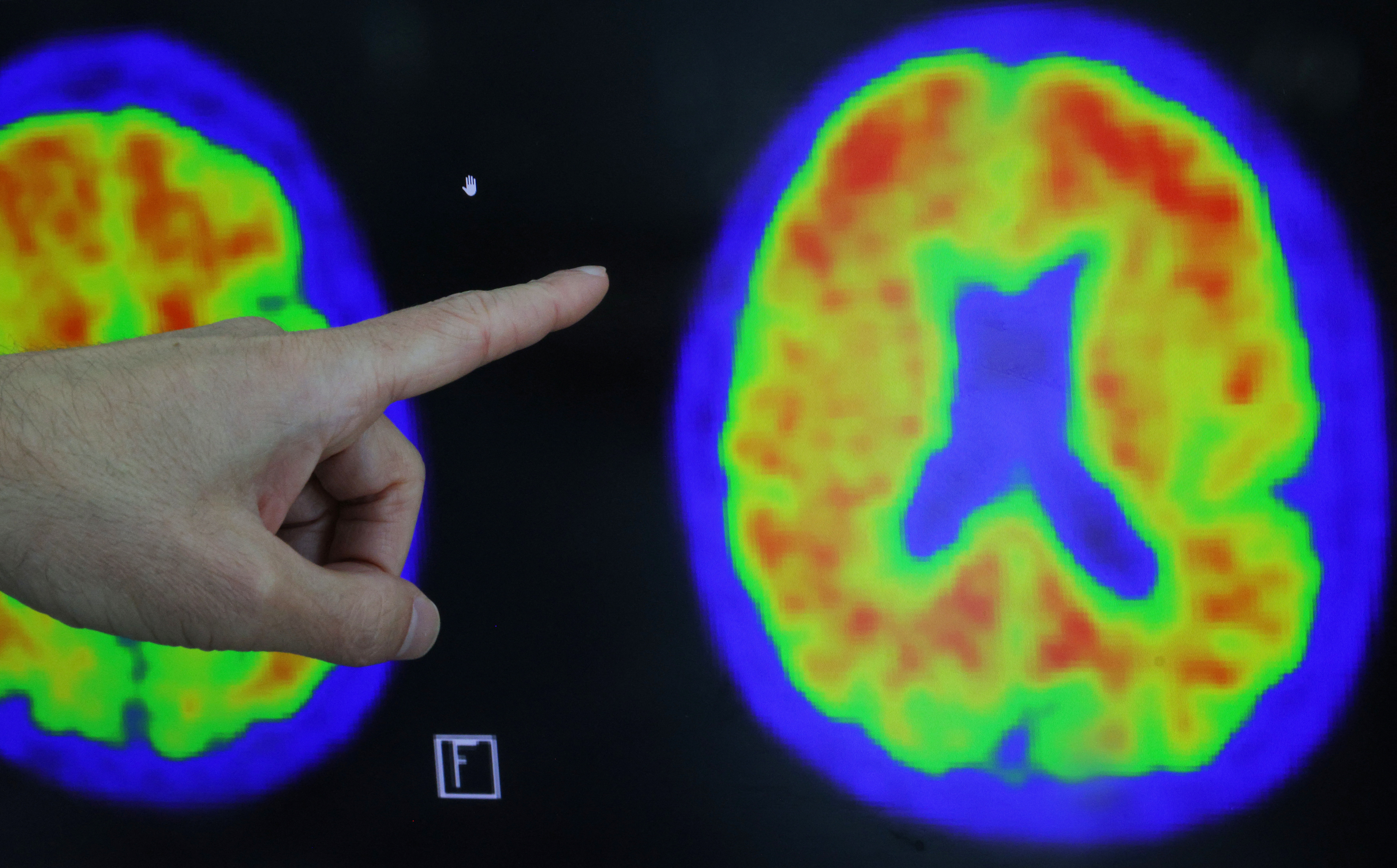 Aunque suele desarrollarse sin síntomas durante muchos años, generalmente la enfermedad de Alzheimer viene precedida de lo que se conoce como deterioro cognitivo leve    REUTERS/Brian Snyder
