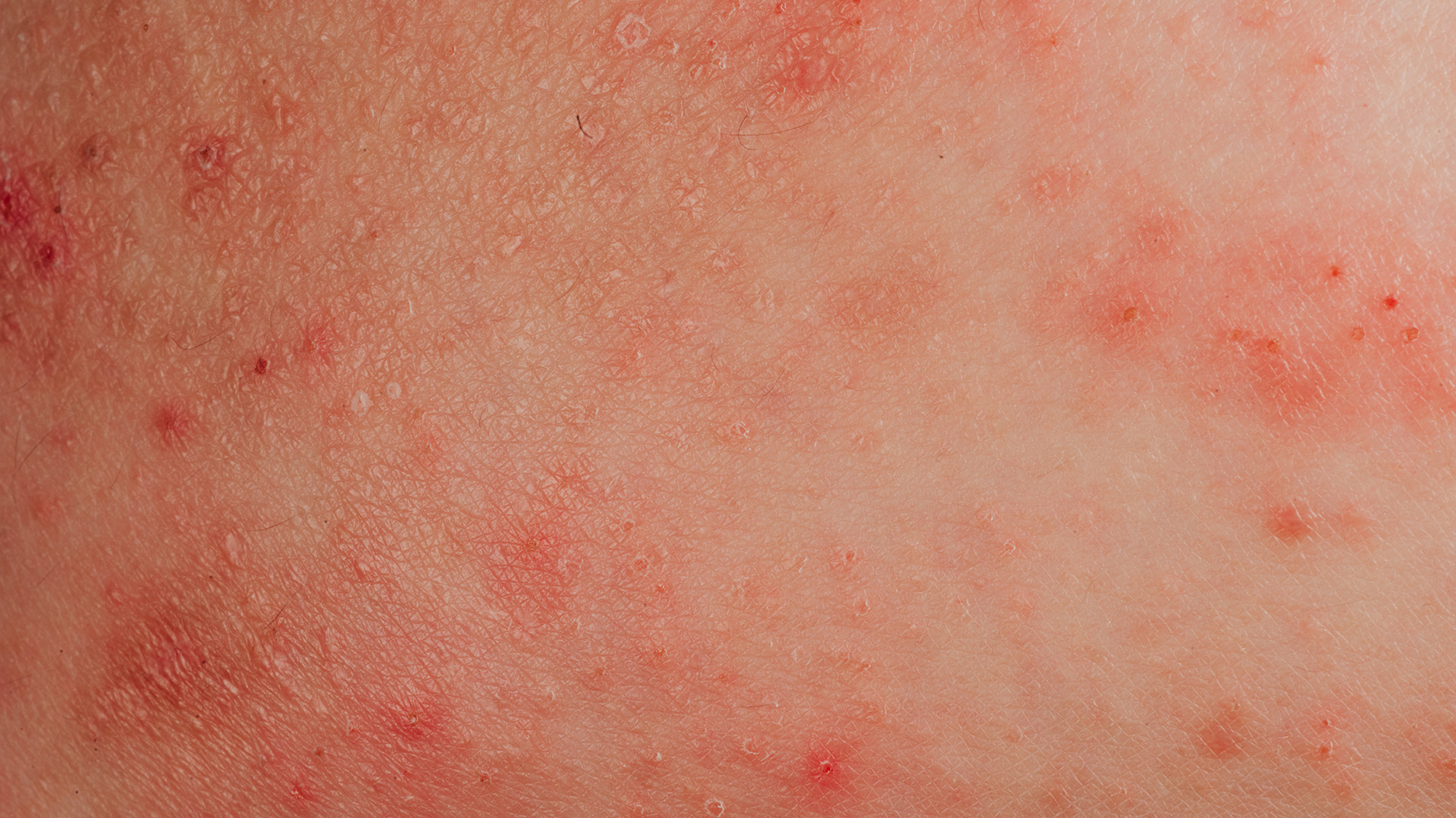Es muy frecuente que la dermatitis coexista con otras enfermedades alérgicas, como asma, rinoconjuntivitis o alergia alimentaria (Getty Images)