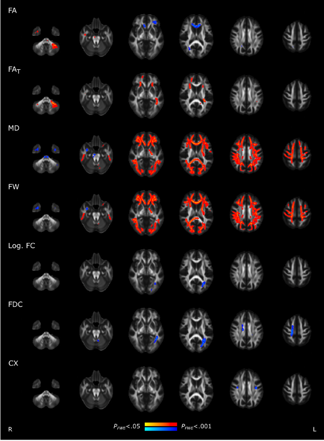 Los 2 hallazgos de resonancia magnética, difusividad media y agua libre, ambos indicativos de inflamación cerebral, resaltados en rojo, exhibieron diferencias significativas entre los individuos con COVID vs control