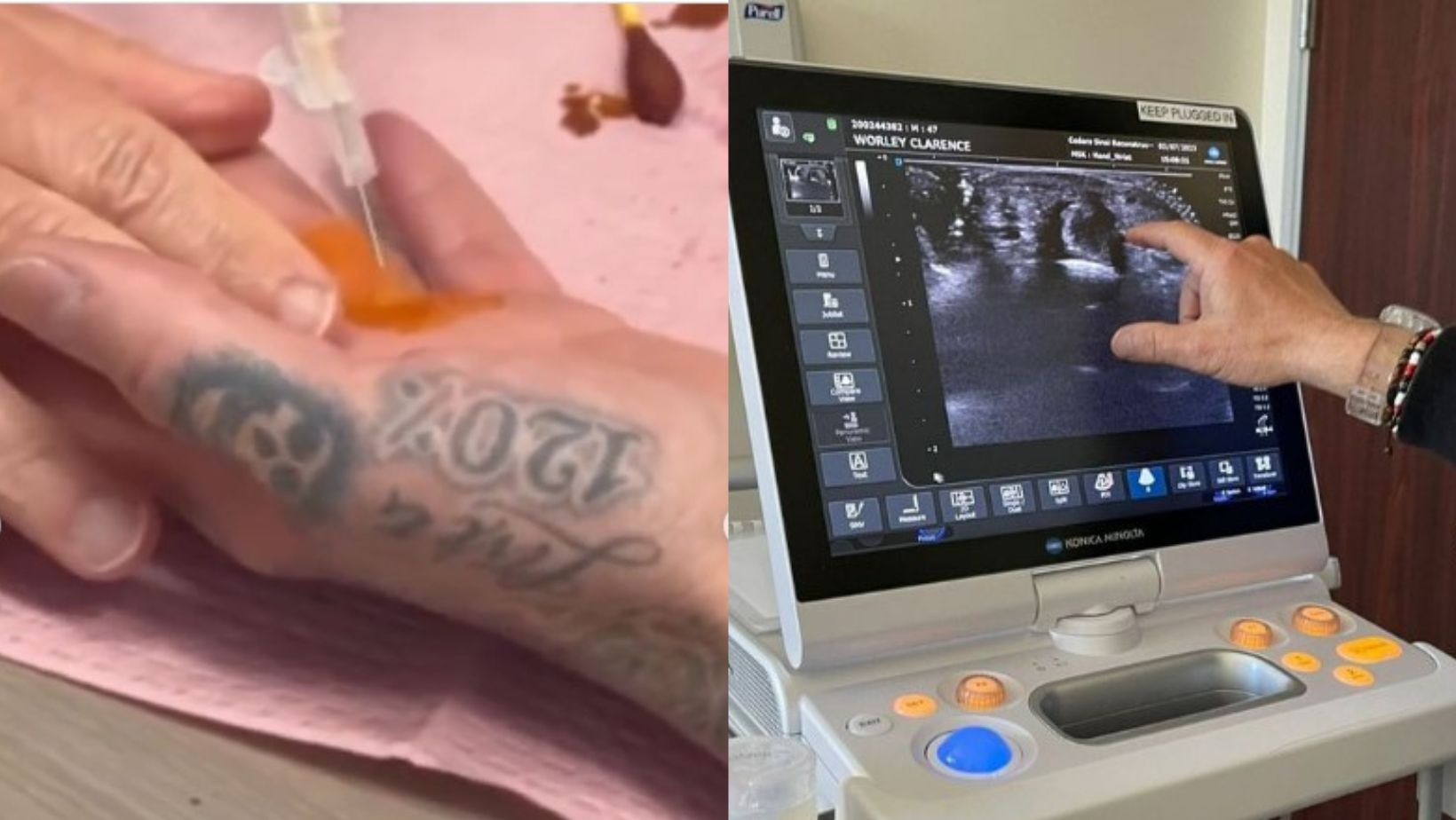 Travis Barker compatió el proceso donde le aplicaron dos inyecciones en su dedo lastimado.
(@travisbarker)