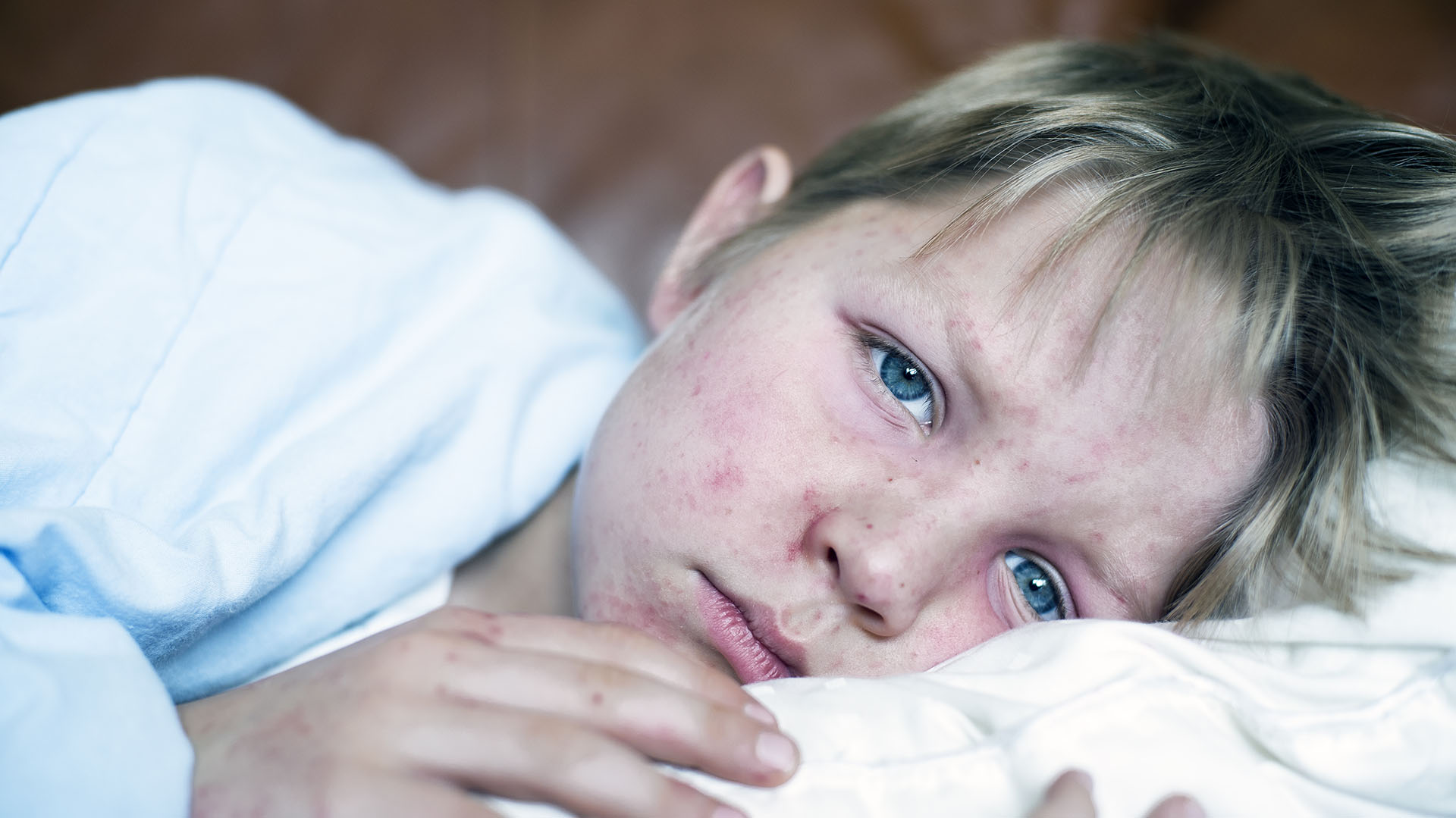 El virus sarampión puede afectar tanto a adultos como a niños. Pero en las infancias puede ser grave e incluso mortal (Getty Images)