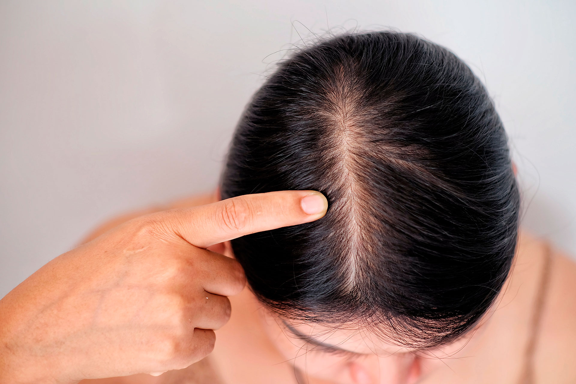 Regresa Dispersión Ausencia Pérdida de pelo: 1 de cada 6 mujeres sufre de alopecia - Infobae