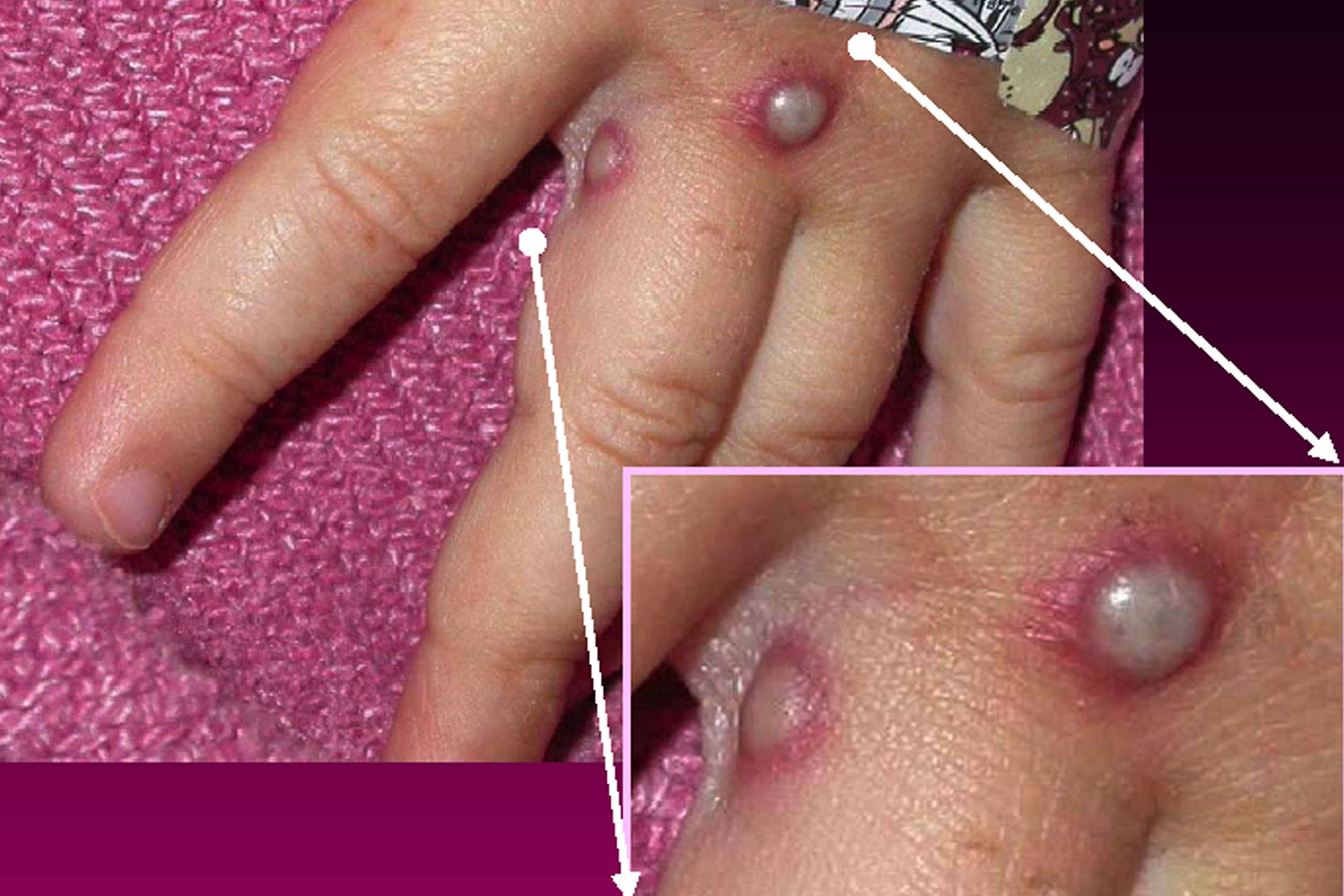 Las diferentes lesiones en la piel son síntomas de viruela. Muchos de los pacientes tienen lesiones genitales/ CDC/Getty Images) 