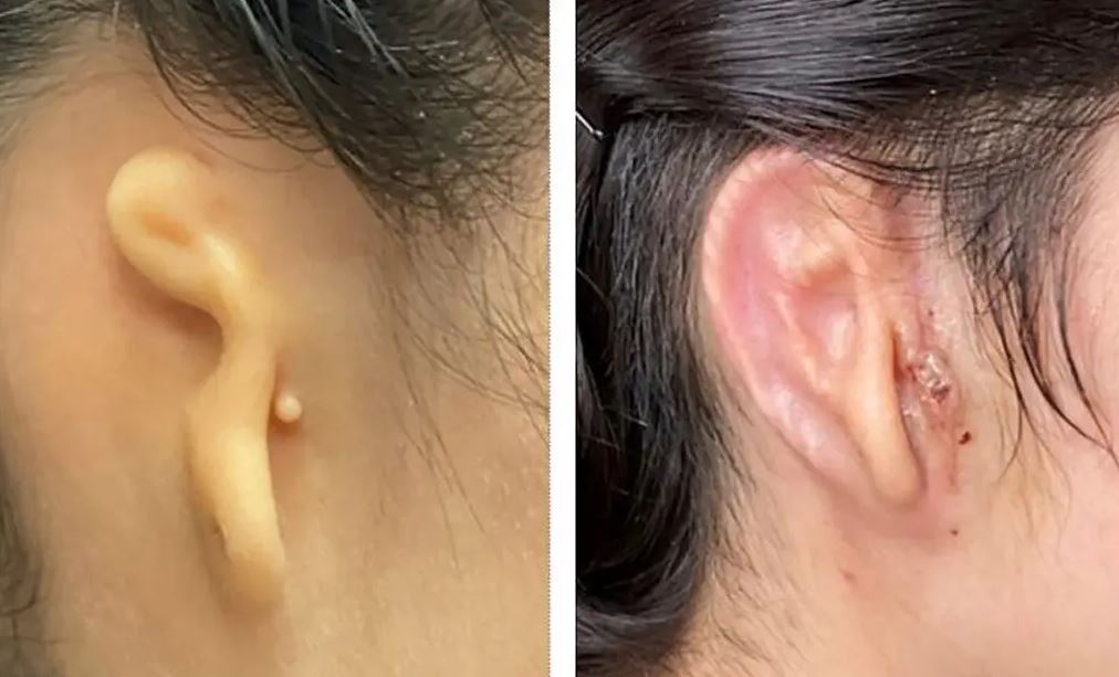 Alexa, con su oreja de nacimiento y después de 30 días de operada. (Dr. Arturo Bonilla, Microtia-Instituto Congénito del Oído)