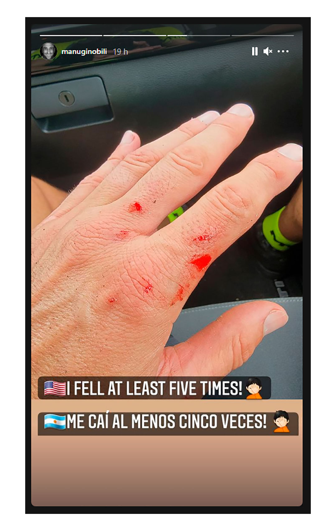 La foto que publicó Ginóbili sobre cómo quedaron sus manos después de practicar mountain bike