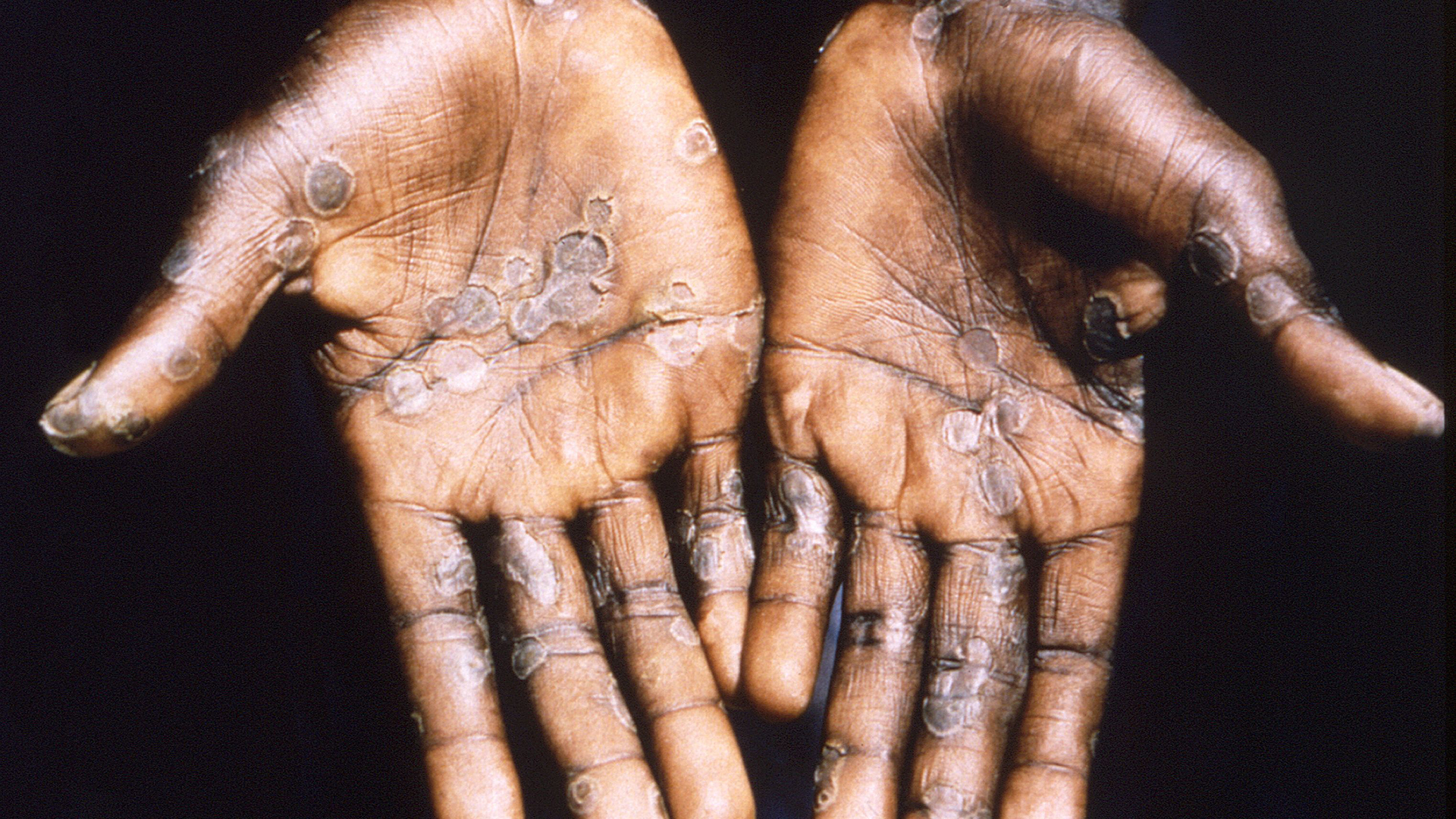 Las palmas de las manos de un paciente con viruela del mono en la República Democrática del Congo (Brian W.J. Mahy/CDC/Handout via REUTERS/Archivo)