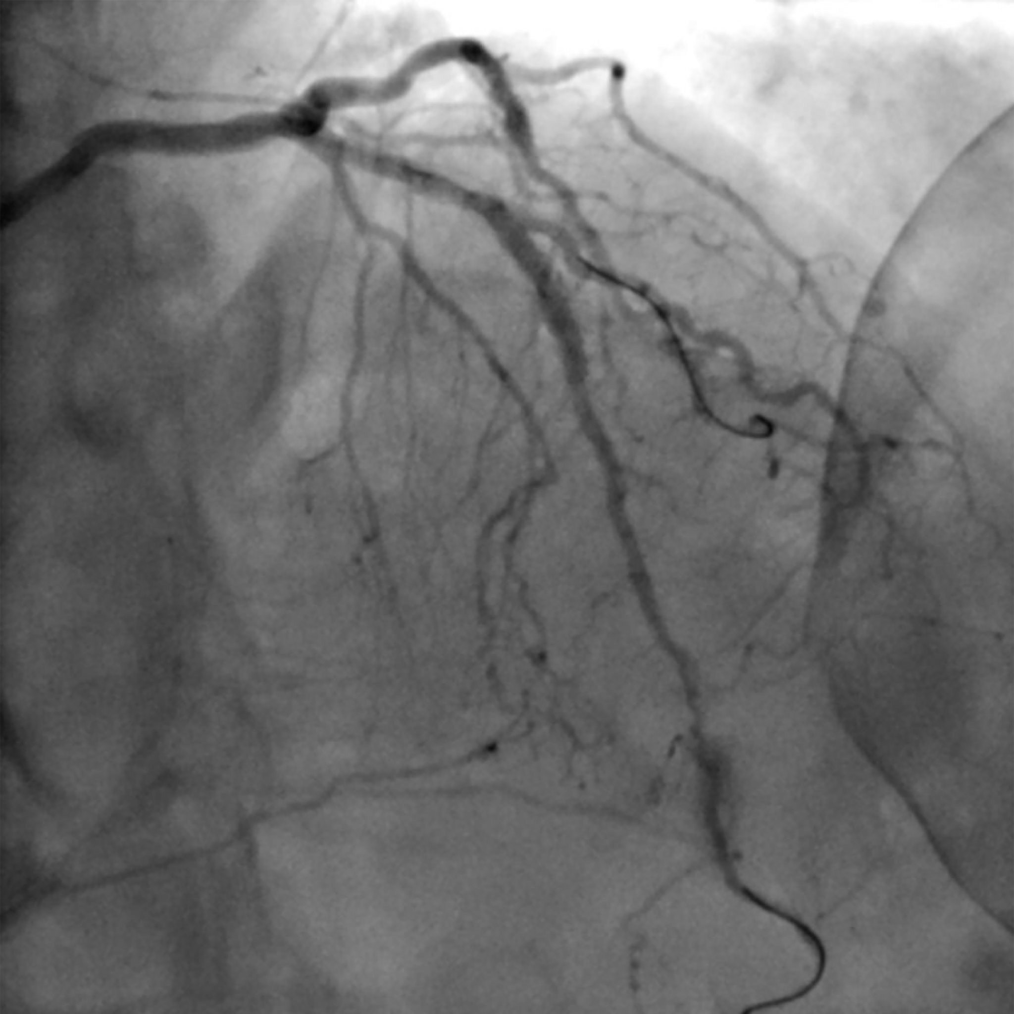 Los autores no encontraron diferencias materiales entre la CCTA y la angiografía en la incidencia del resultado primario (NYU Langone Health)
