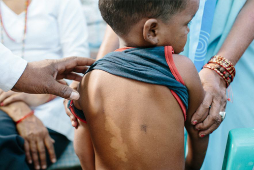 En América Latina, entre 2011 y 2020 se notificaron 301.312 casos de personas diagnosticadas con lepra. Brasil es el país con más casos/Archivo