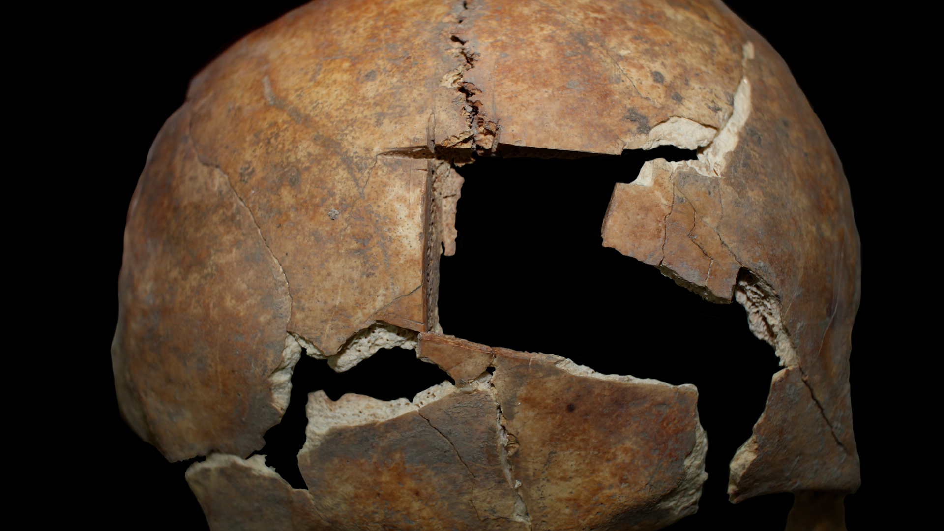 Hace más de 3.500 años ya se hacían cirugías del cerebro en Medio Oriente