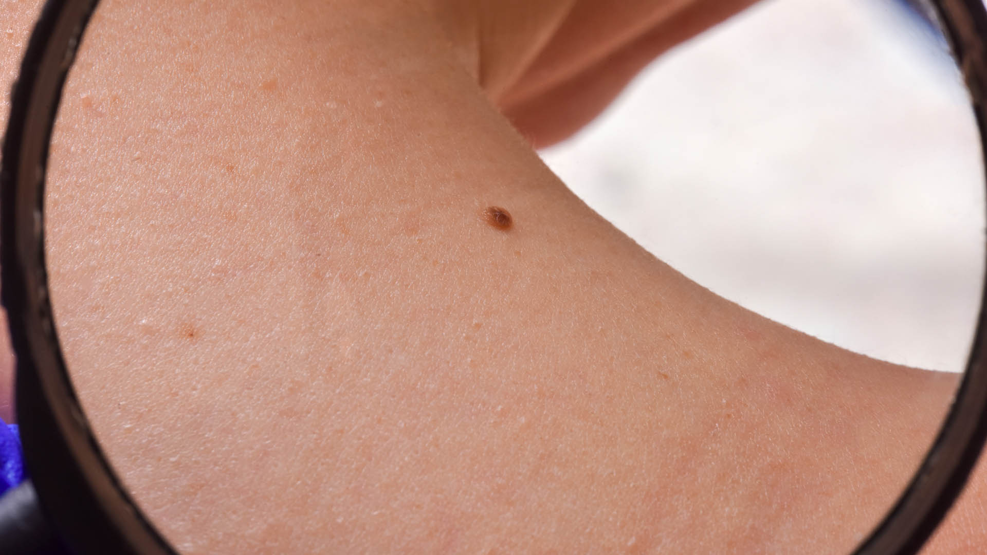 Melanoma: el diagnóstico precoz es clave ante la forma más peligrosa de cáncer de piel