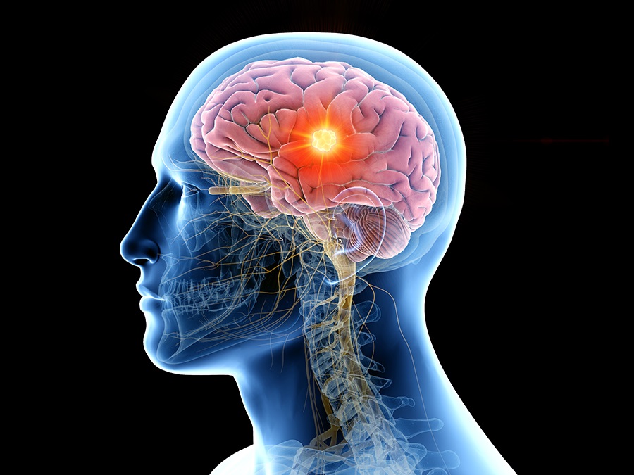 Los tumores cerebrales representan el 2% de las enfermedades oncológicas y pueden desarrollarse en cualquier momento de la vida