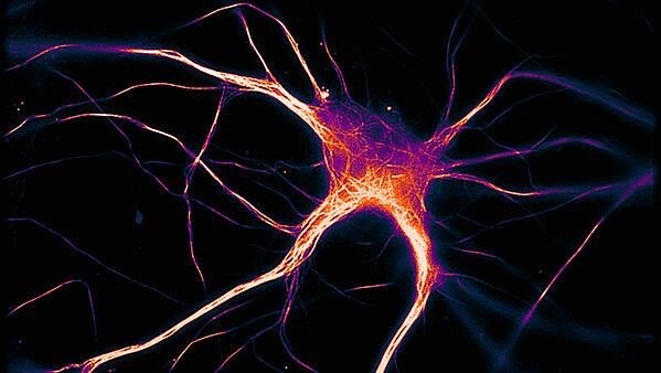 Placas de proteínas se acumulan entre las neuronas y podrían ser una de las causas del Alzheimer (Archivo)