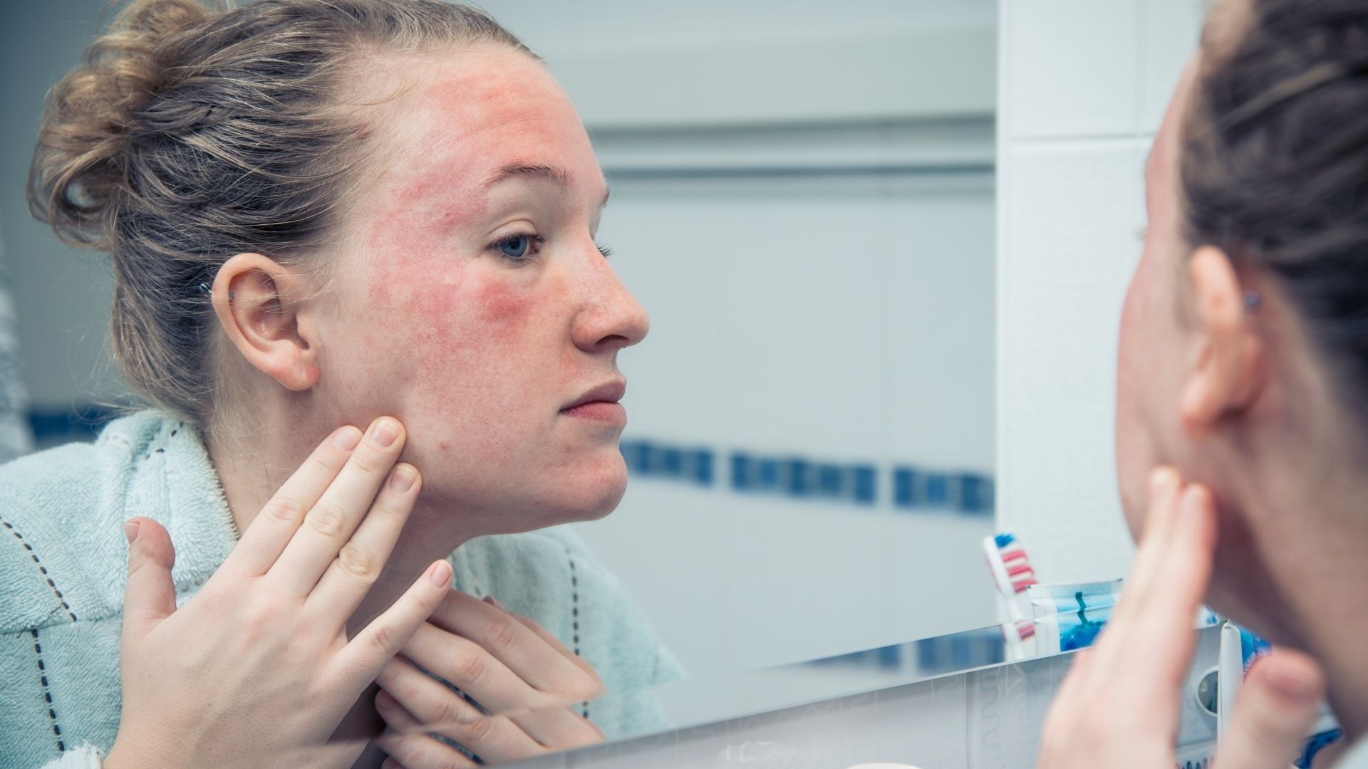 El acné, la rosácea, la psoriasis y el incremento de vitiligo son algunas enfermedades de la piel que pueden ser producto de la ansiedad (Getty)