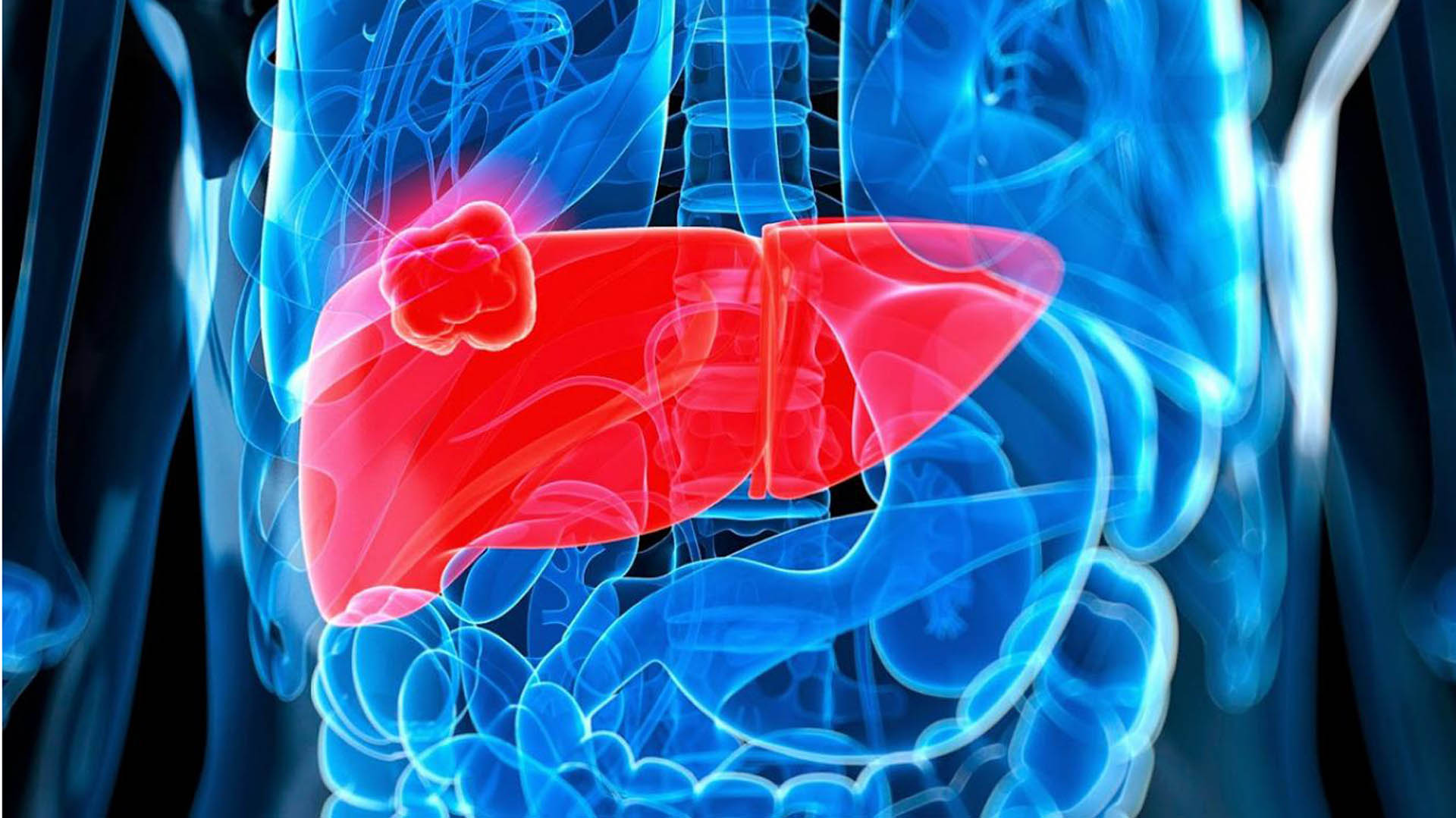 Los cánceres de hígado afectan principalmente a personas con cirrosis, hepatitis C, alcoholismo o hígado graso no alcohólico