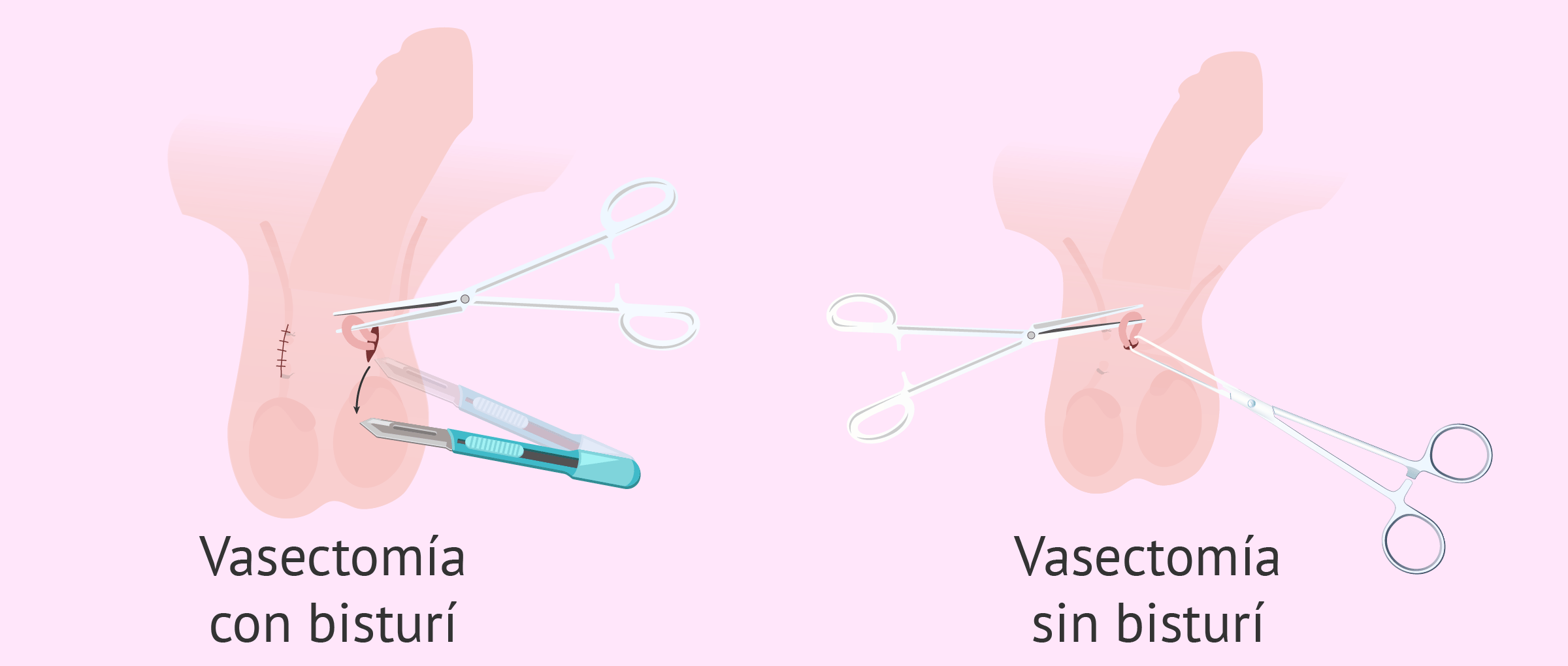 Así son las dos técnicas de la vasectomía (Foto: especial)