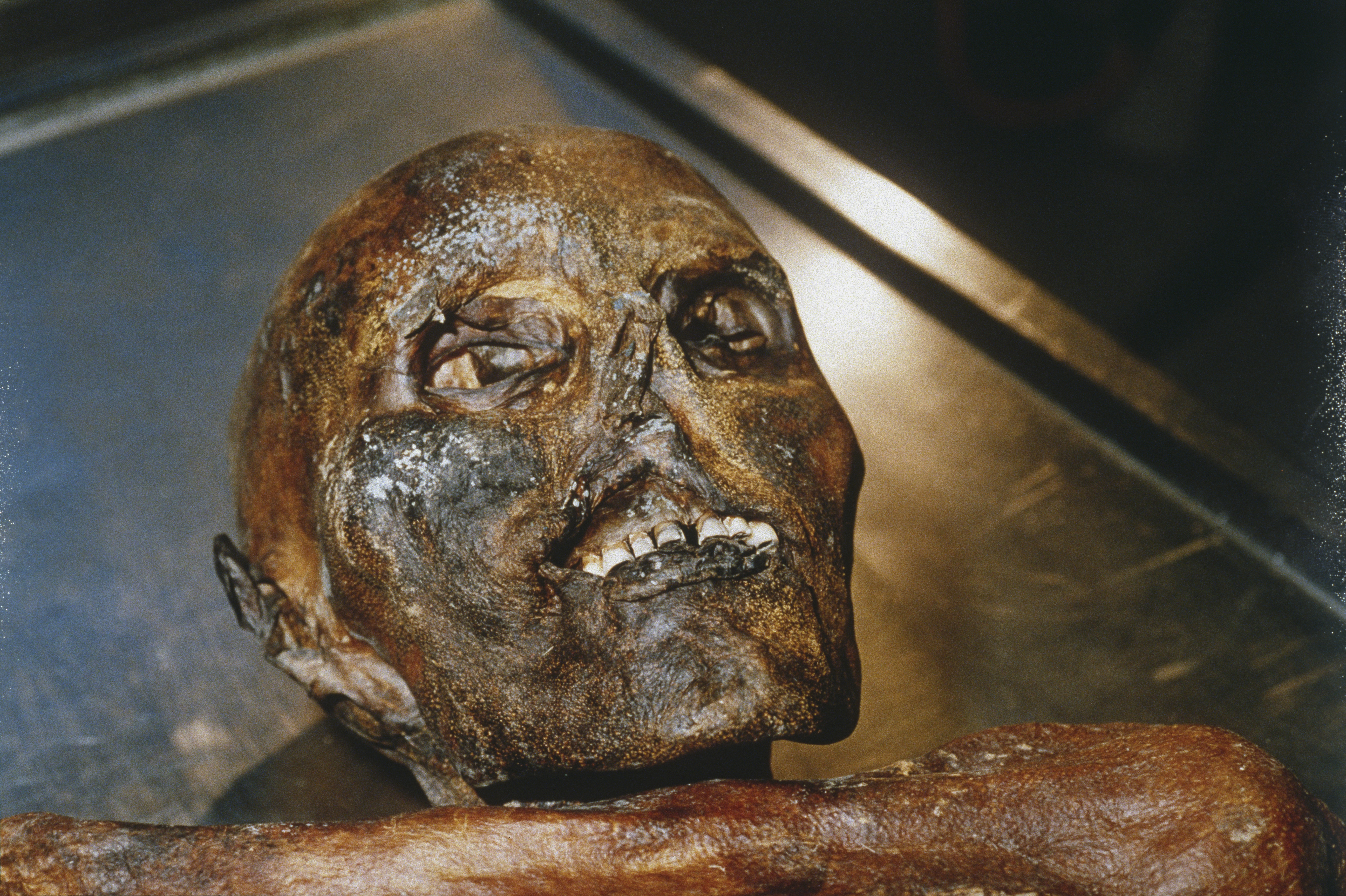 El rostro momificado de Ötzil. En el análisis forense descubrieron que era intolerante a la lactosa, que tenía caries dentales y que padecía de una artritis avanzada (Leopold Nekula/Sygma via Getty Images)