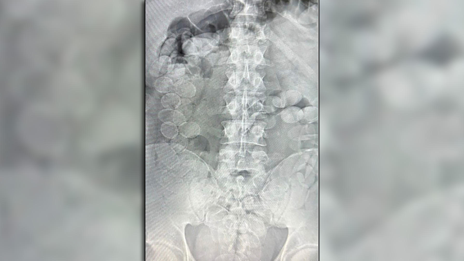 Viajaban en un micro con c&aacute;psulas de coca&iacute;na en su cuerpo y los descubrieron: los condenaron a 4 a&ntilde;os de prisi&oacute;n