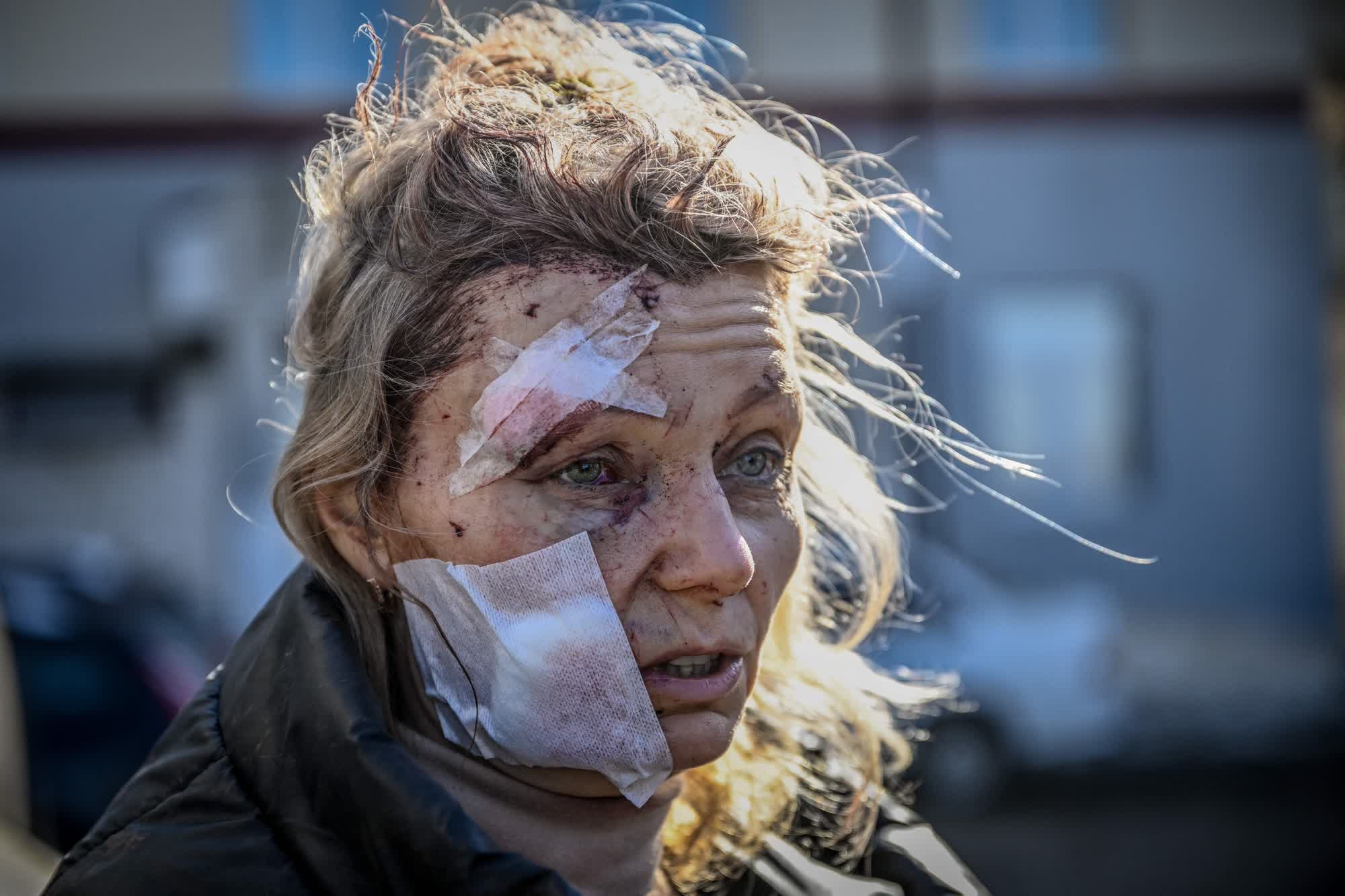 Elena, maestra de Chuhuiv, después de ser curada de las heridas que le provocó la caída de un misil en su casa. (Aris Messinis/AFP)