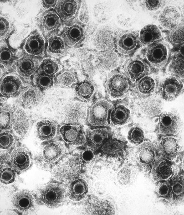 El virus del Herpes puede ser una de las causas de la encefalitis
